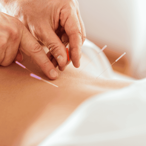 Behandeling acupunctuur Spijkenisse