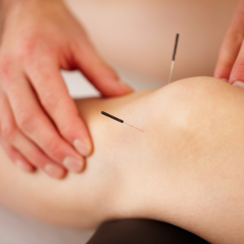 Acupunctuurbehandeling bij hernia met zenuwpijn
